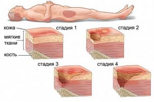 До какво води залежаването? Декубитус и декубитални рани. Възстановяване 1 декубитални рани, залежаване