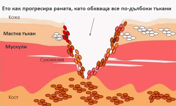 До какво води залежаването? Декубитус и декубитални рани. Възстановяване 3 dekubitalni-rani-07