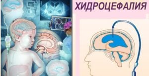 Хидроцефалия (вода в главата) при деца и възрастни. Различия, симптоми, терапия 1 симптоми на хидроцефалия, лечение