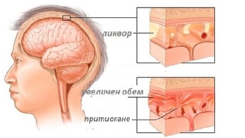 Хидроцефалия (вода в главата) при деца и възрастни. Различия, симптоми, терапия 3 симптоми на хидроцефалия, лечение