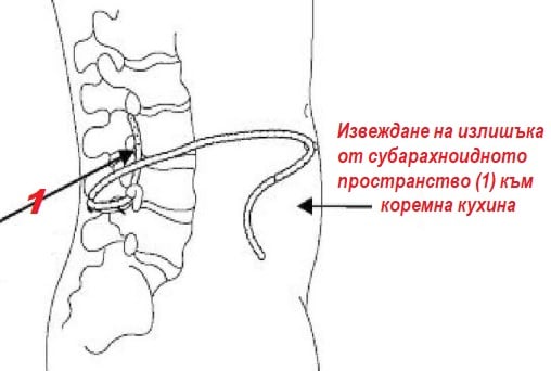Хидроцефалия (вода в главата) при деца и възрастни. Различия, симптоми, терапия 9 симптоми на хидроцефалия, лечение